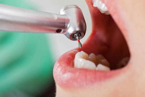 Best Emergency Wisdom Teeth Removal in North Myrtle Beach, SC